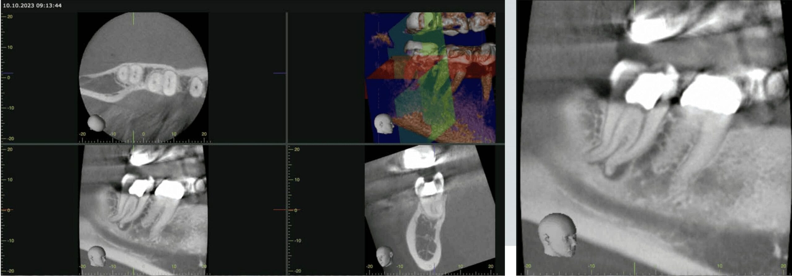 endodontic treatment