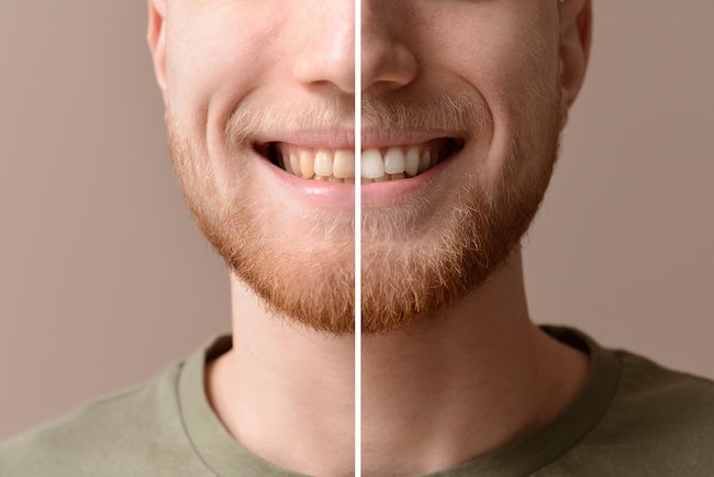 Teeth cleaning